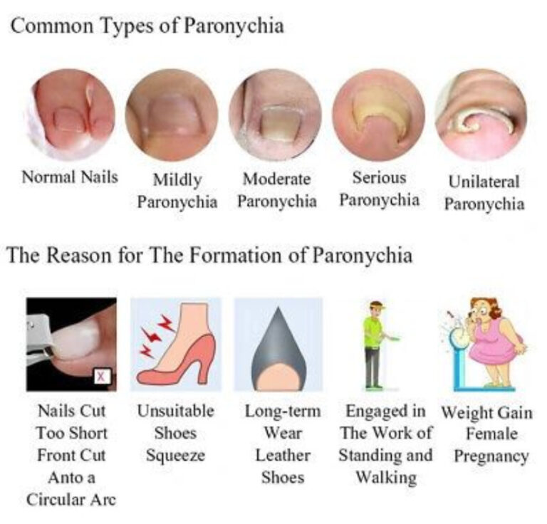 Onyfix Nail Correction Waterford Foot Clinic